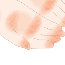湿疹 手の甲